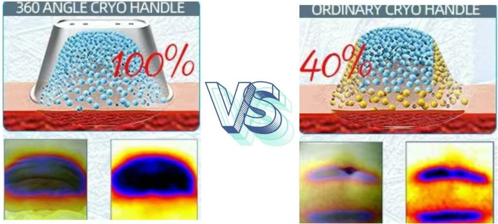 CryoSculpt Pro 360 VS Ordinary cryolipolysis CryoSculpt Pro 360 VS Ordinary cryolipolysis