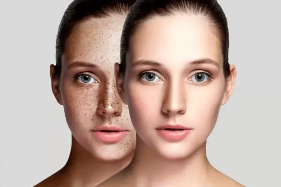 Pigment & Tattoo Treatment