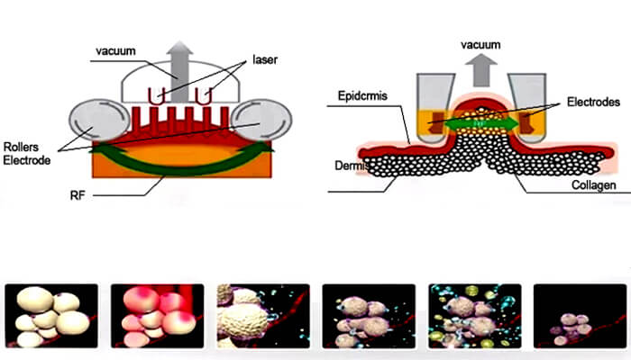 CelluTone Pro treatment principle CelluTone Pro treatment principle