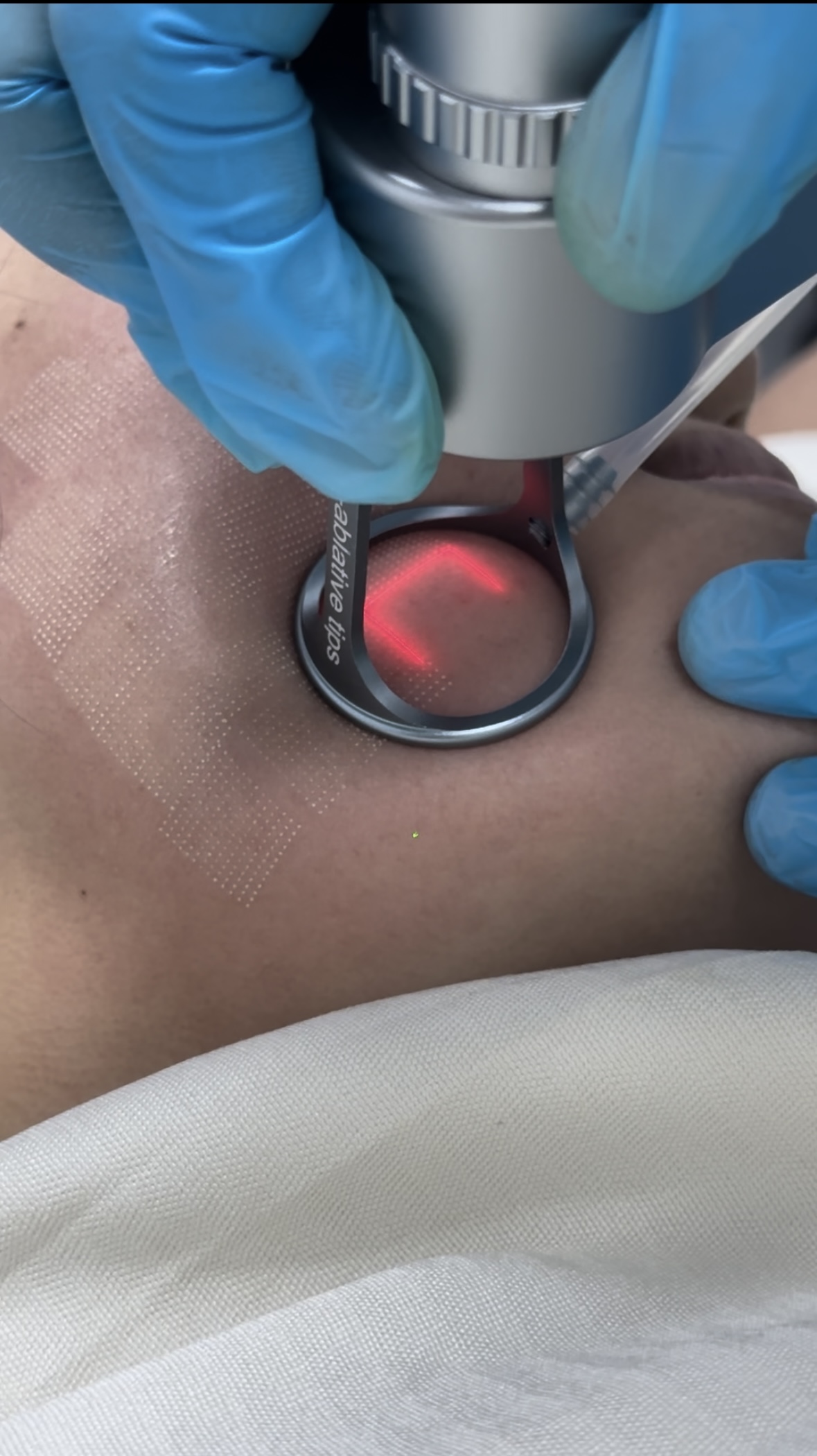 Fractional CO2 Laser machine