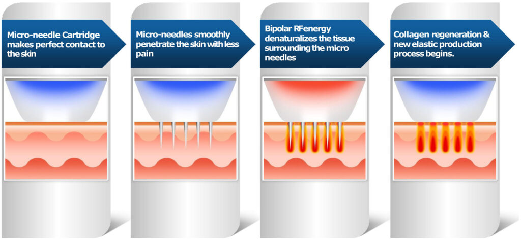 RF Microneedling Working