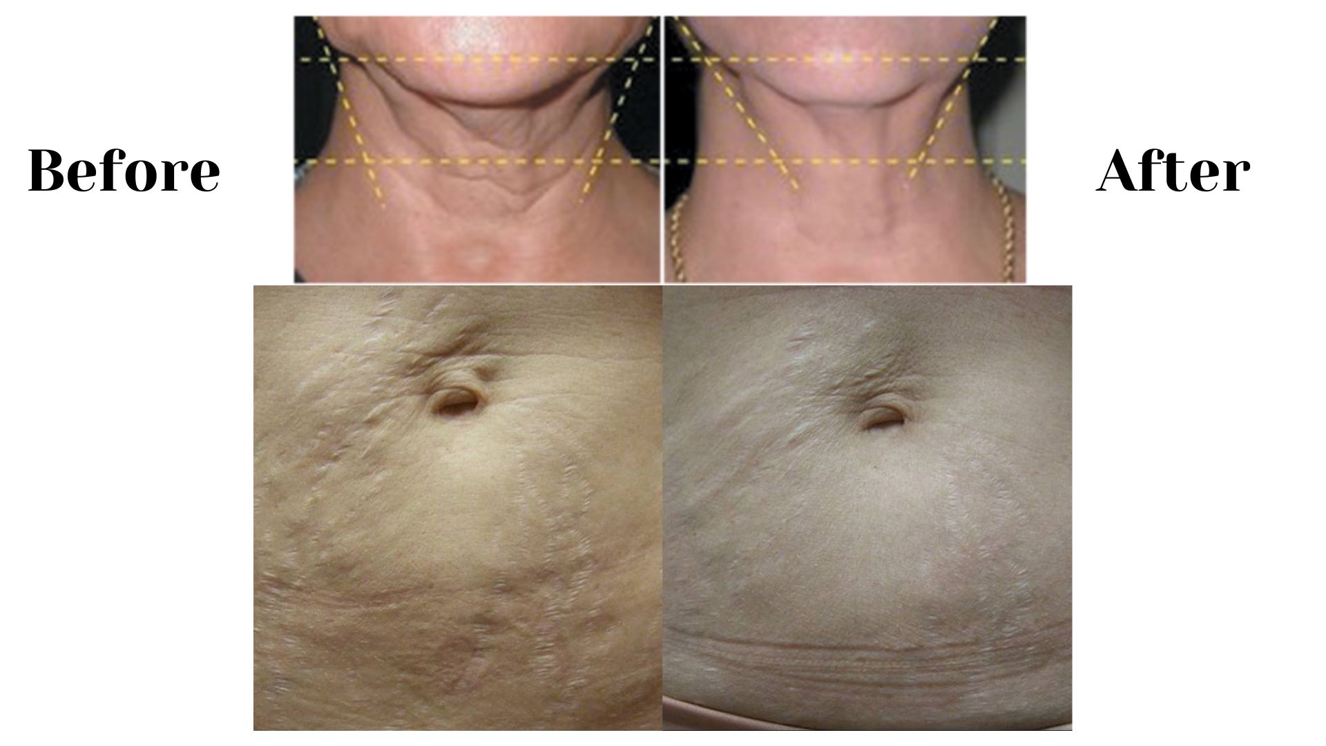 Lumi Revive Pro PDT LED Before & After Lumi Revive Pro PDT LED Before & After