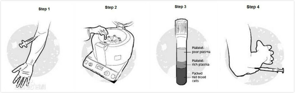 PRP procedure(1) PRP procedure(1)