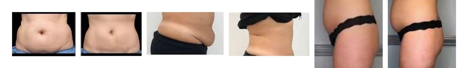 Before and after of CryoSculpt Pro 360 Before and after of CryoSculpt Pro 360