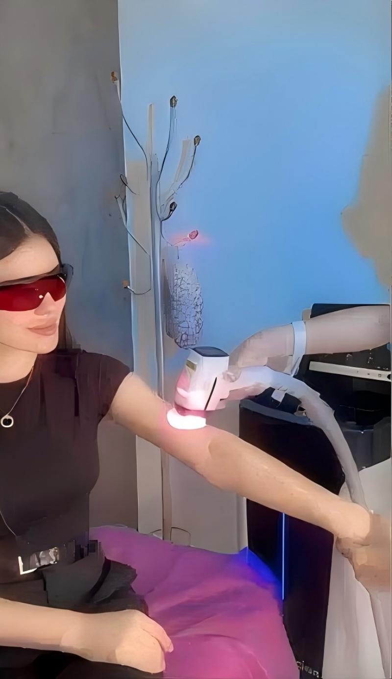 Diode Laser Hair Removal Machine