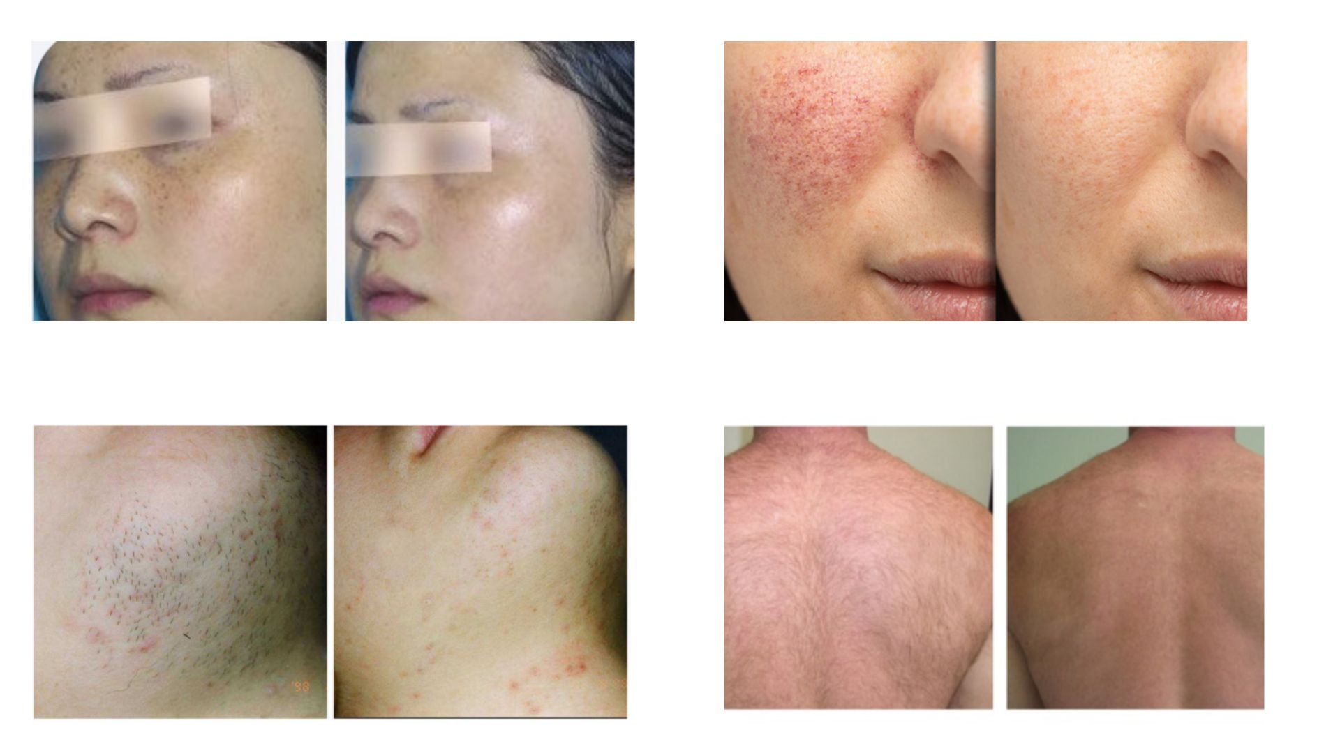 KrysLume Pro IPL before after