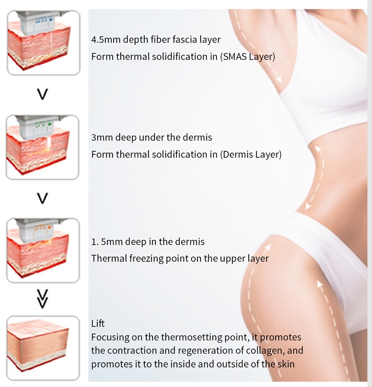 DermaLift 7D HIFU Compact