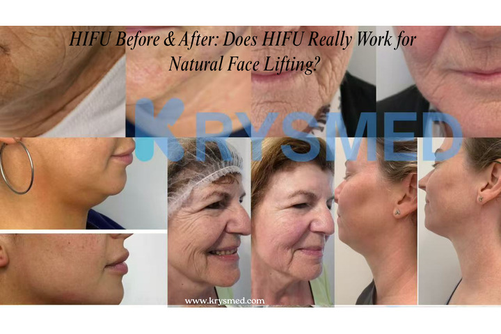 HIFU Before & After: Does HIFU Really Work for Natural Face Lifting?