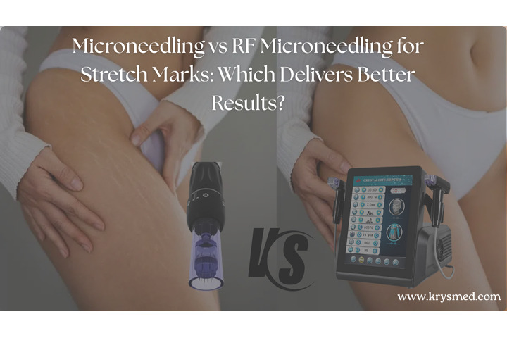 Microneedling vs RF Microneedling for Stretch Marks: Which Delivers Better Results?