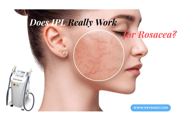 Does IPL Really Work for Rosacea? What Clinics and Patients Should Know