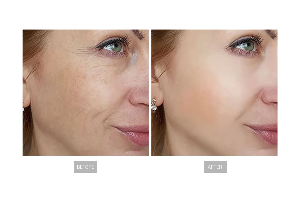 HydraGlow Fusion 9-in-1 before after 