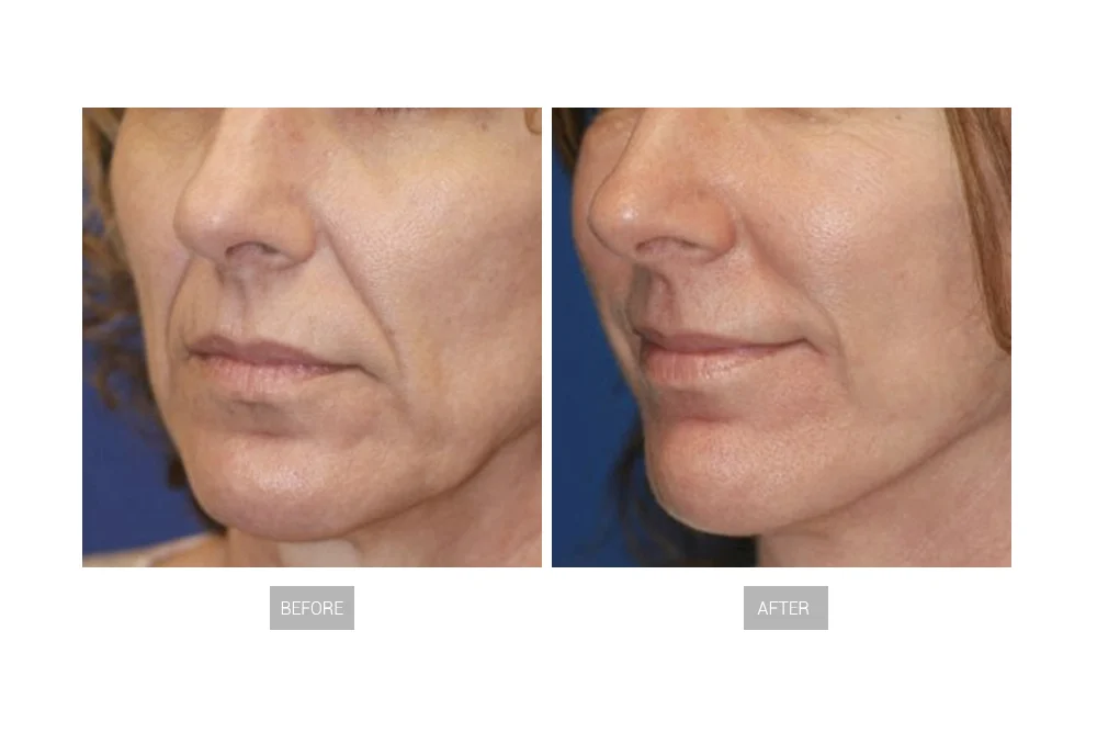 HydraGlow Fusion 9-in-1 before after 1