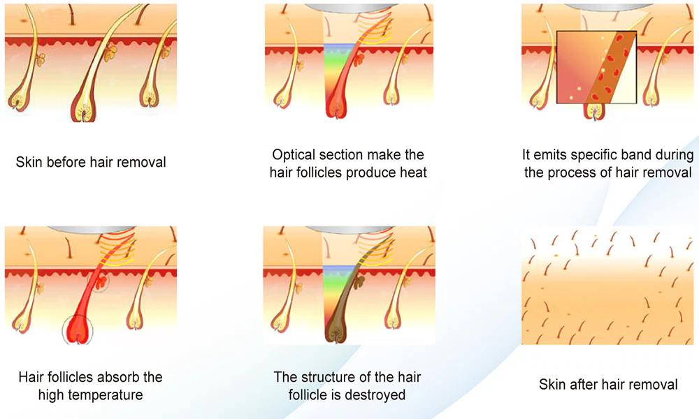Clinical-studies-of-the-IPL-for-hair-removal