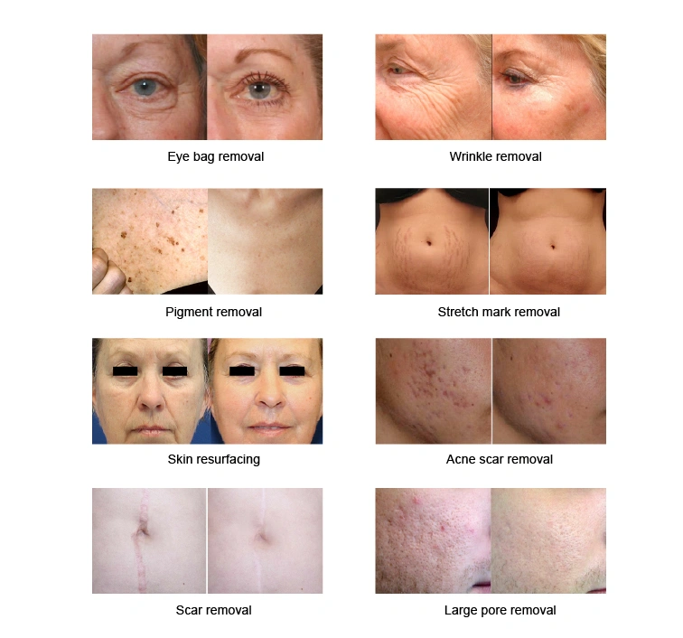 DermaLaser CO₂ before after