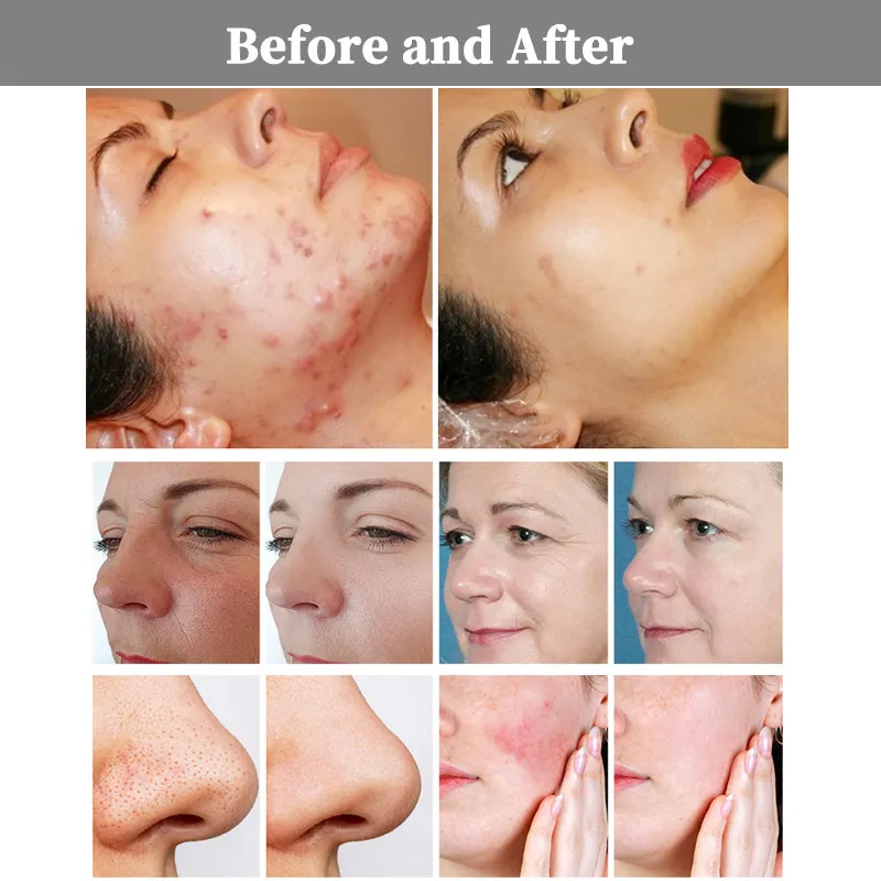 1927nm Thulium laser before and after Krysmed