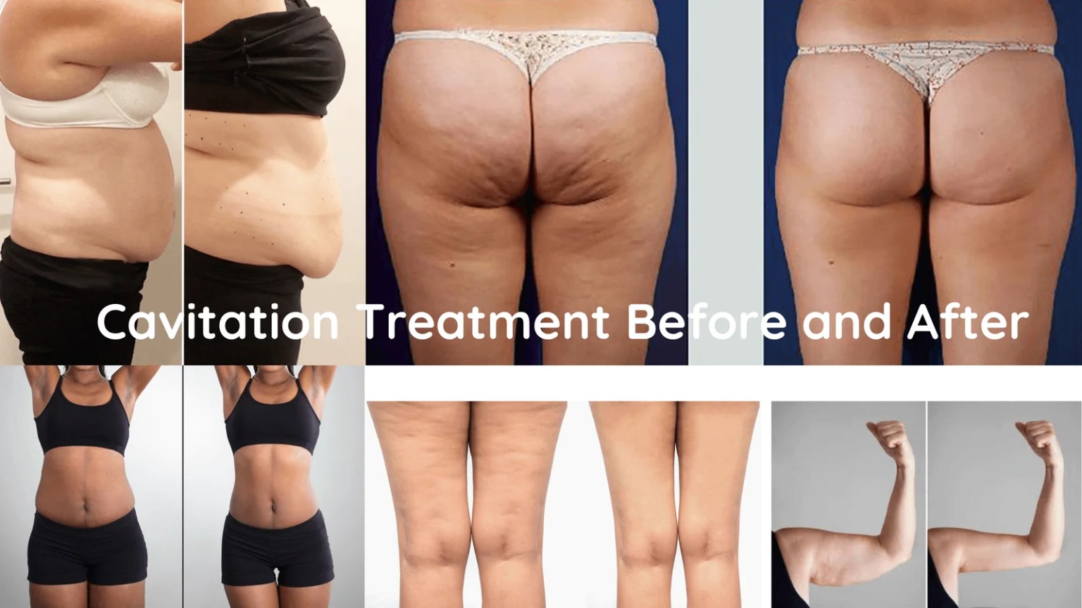 Ultrasonic RF Cavitation before and after Ultrasonic RF Cavitation before and after