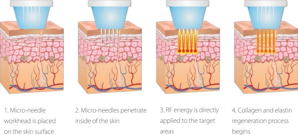 RF Microneedling Working Principle RF Microneedling Working Principle