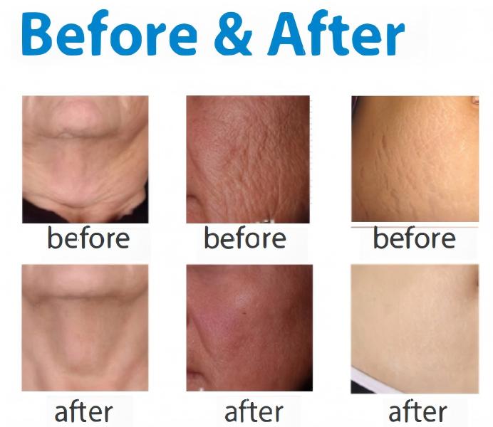 DermaVance S MNRF Before and After DermaVance S MNRF Before and After