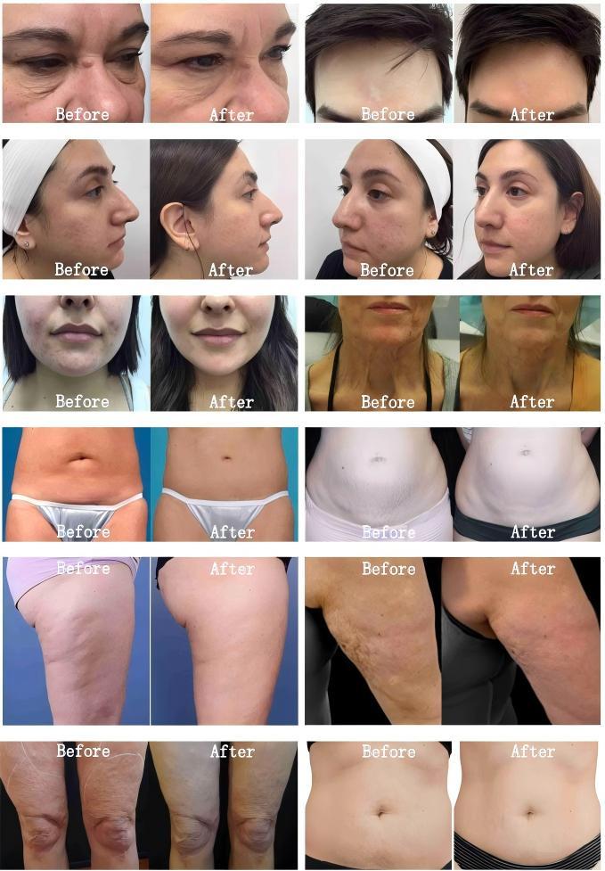 DermaVance Neo RF Microneedling before&after