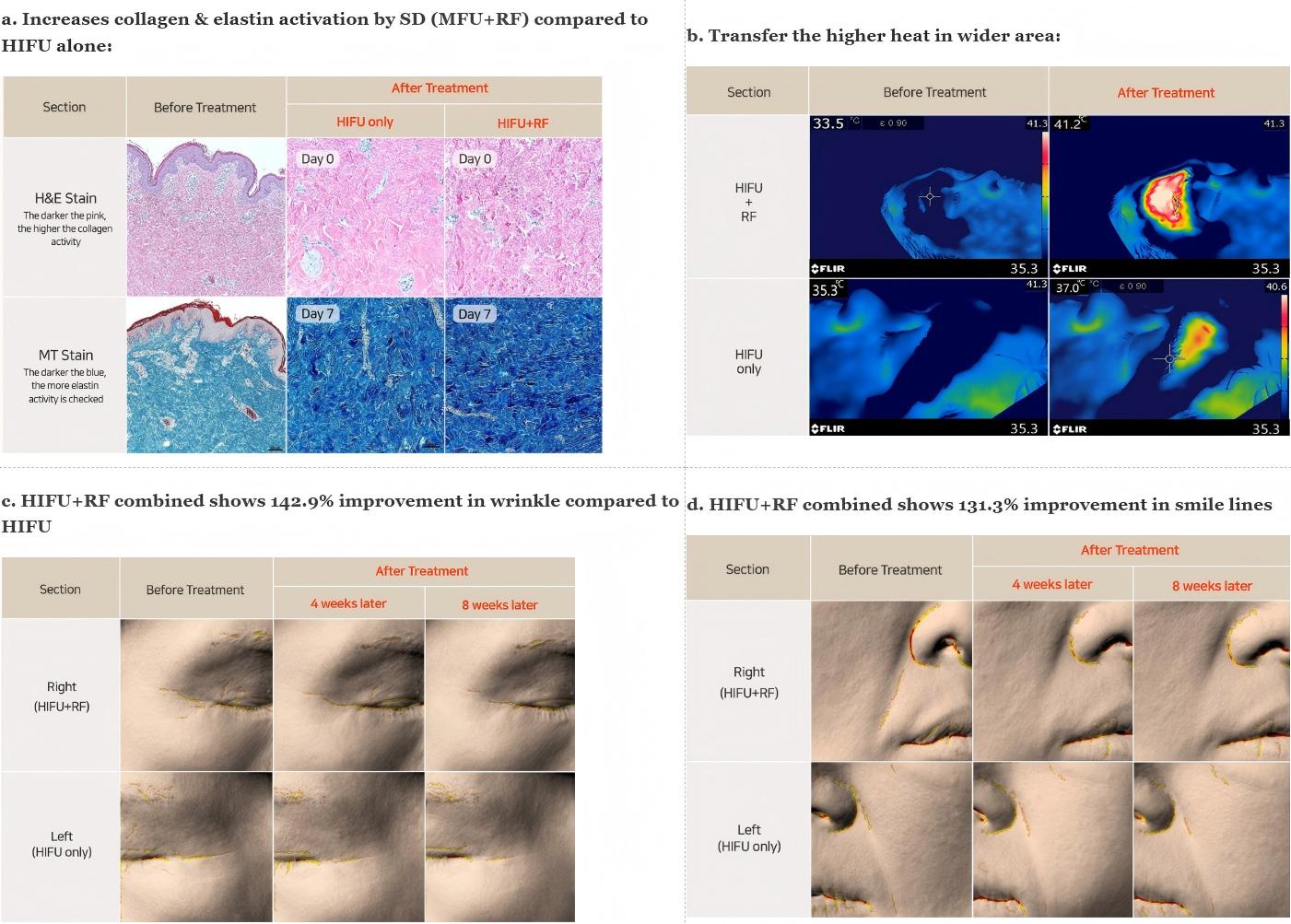 DermaLift SD HIFU results