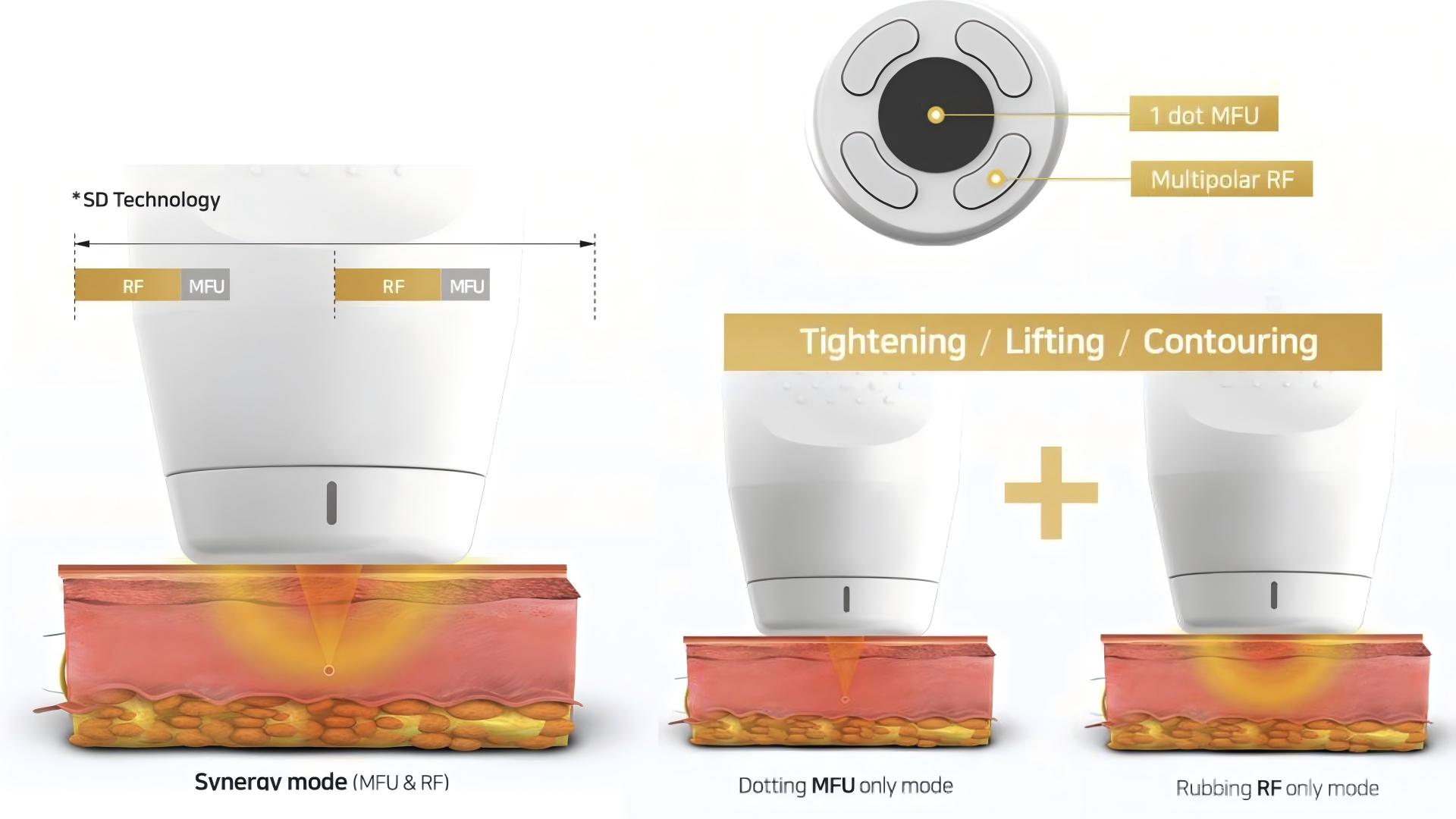 DermaLift SD HIFU SD Technology