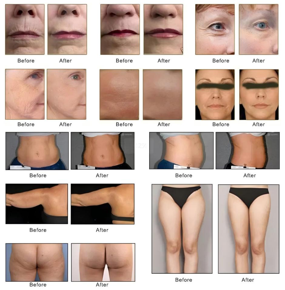 DermaLift SD HIFU before and after