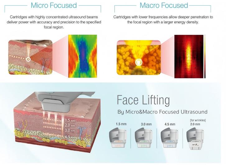 Dermalift 7D HIFU working principle Dermalift 7D HIFU working principle
