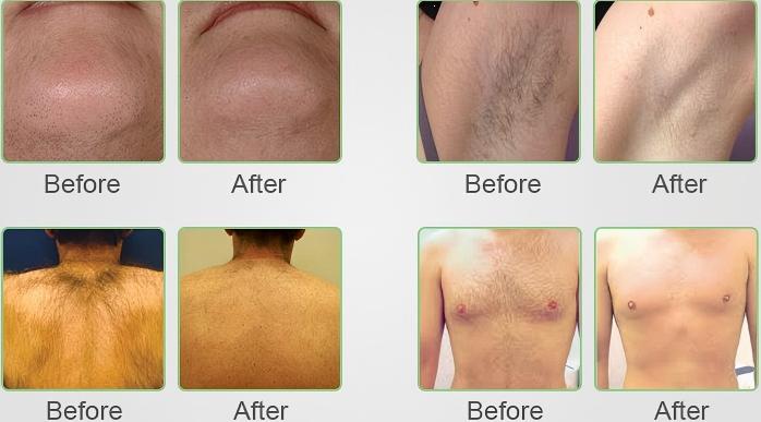 before and after of KrySmooth AI Diode Laser