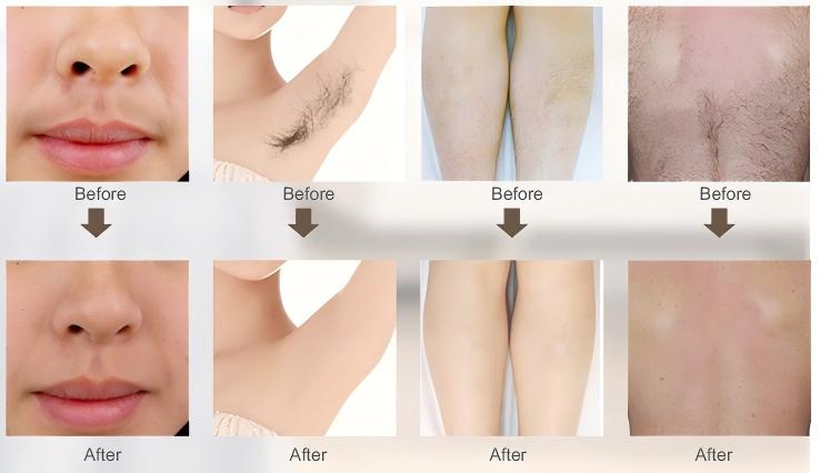 KrySmooth Smart Laser before and after (2) KrySmooth Smart Laser before and after (2)