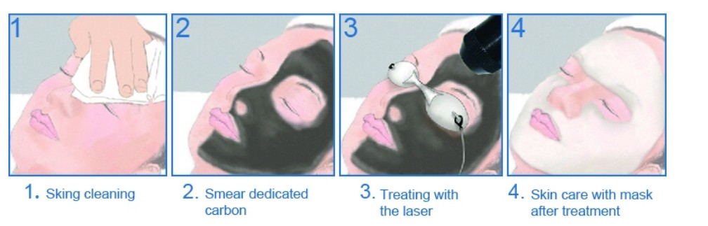 PROCEDURE of LaserTone ND YAG