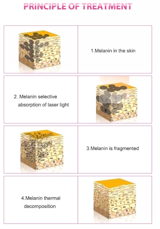 WORKING PRINCIPLE of LaserTone ND YAG