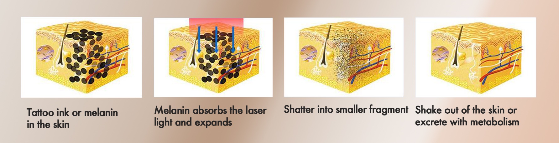 working principle of LaserTone Pico Mini