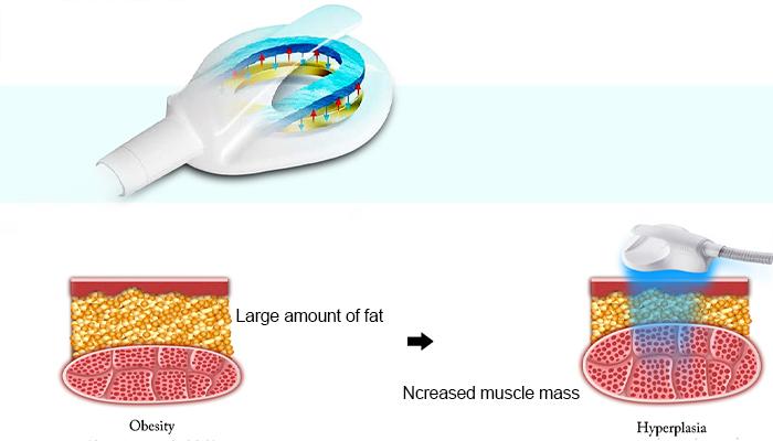 HI-EMT-working-principle