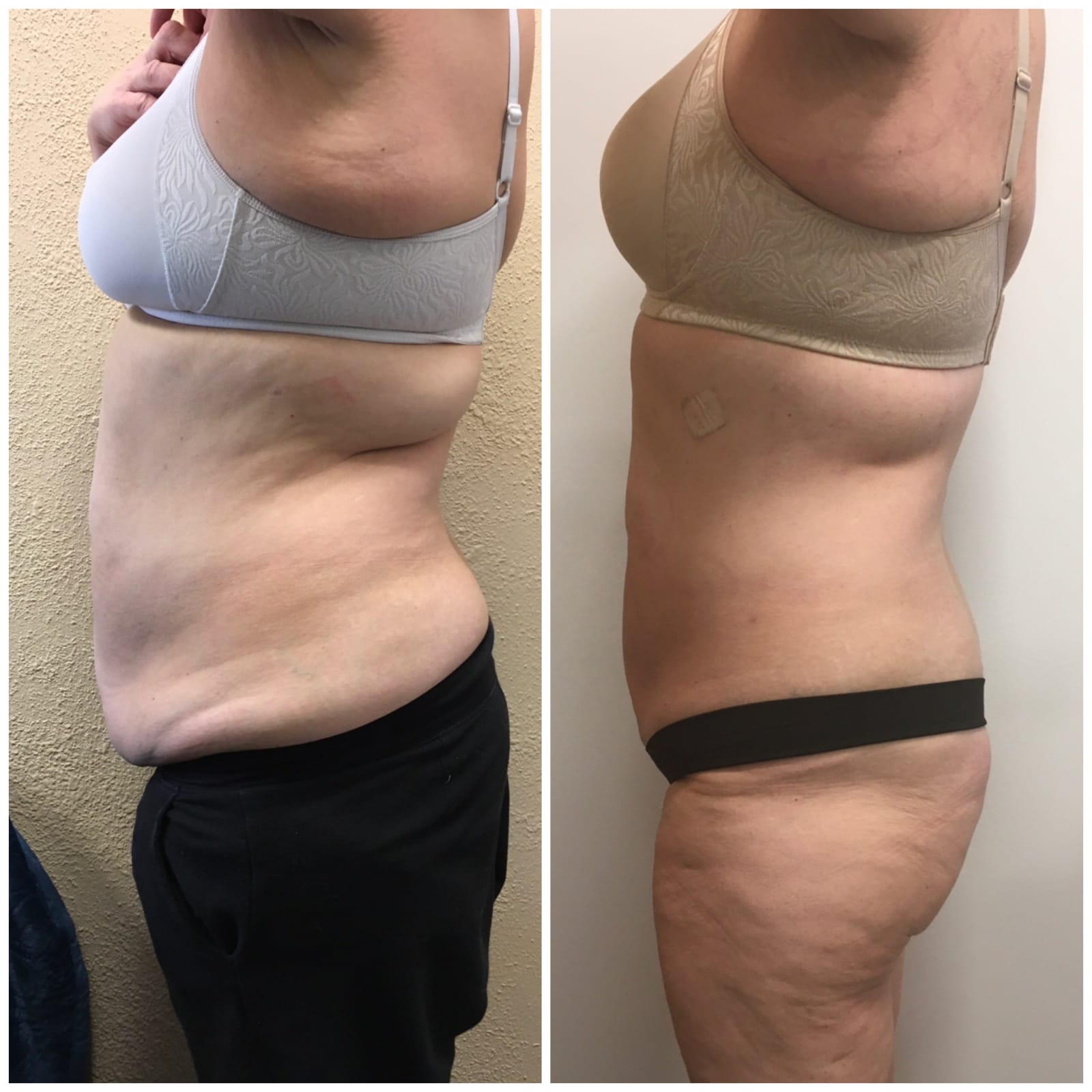 HIFU body contouring 