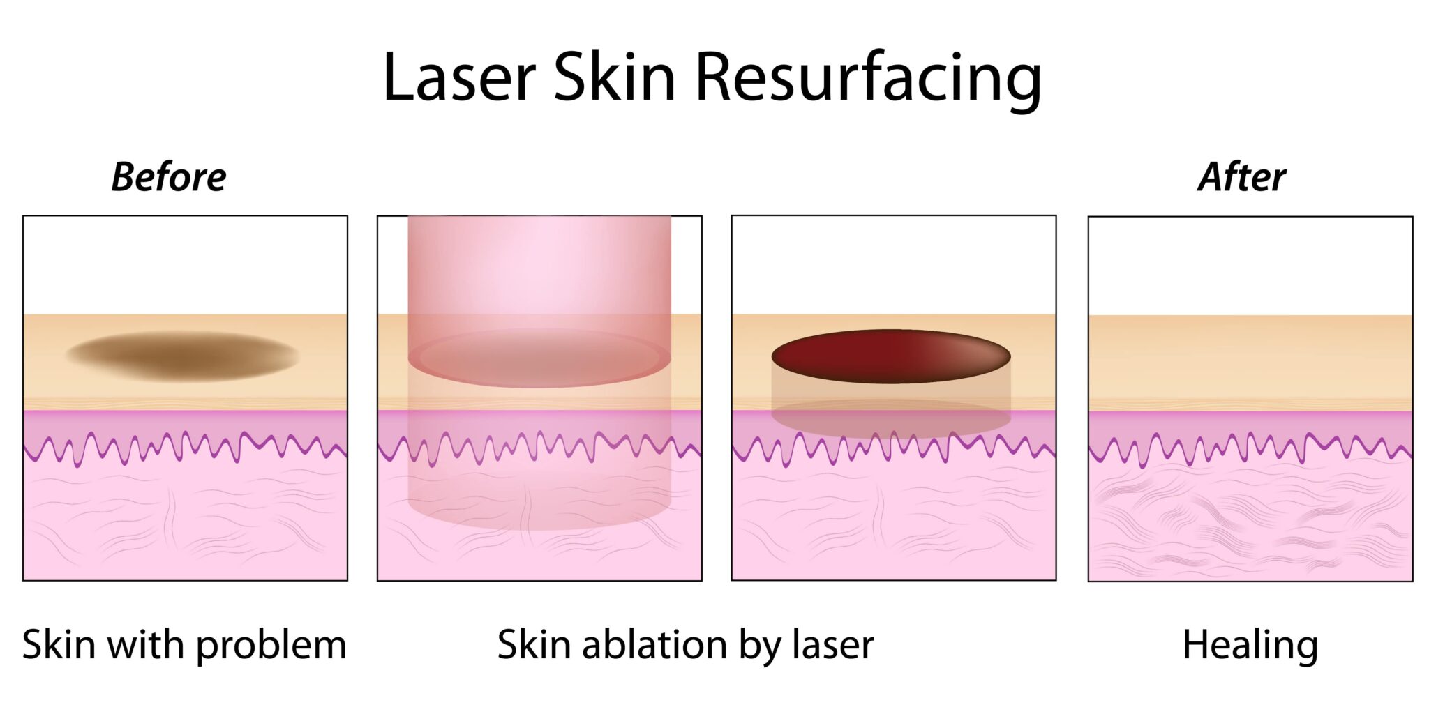 Laser Skin Resurfacing working principle
