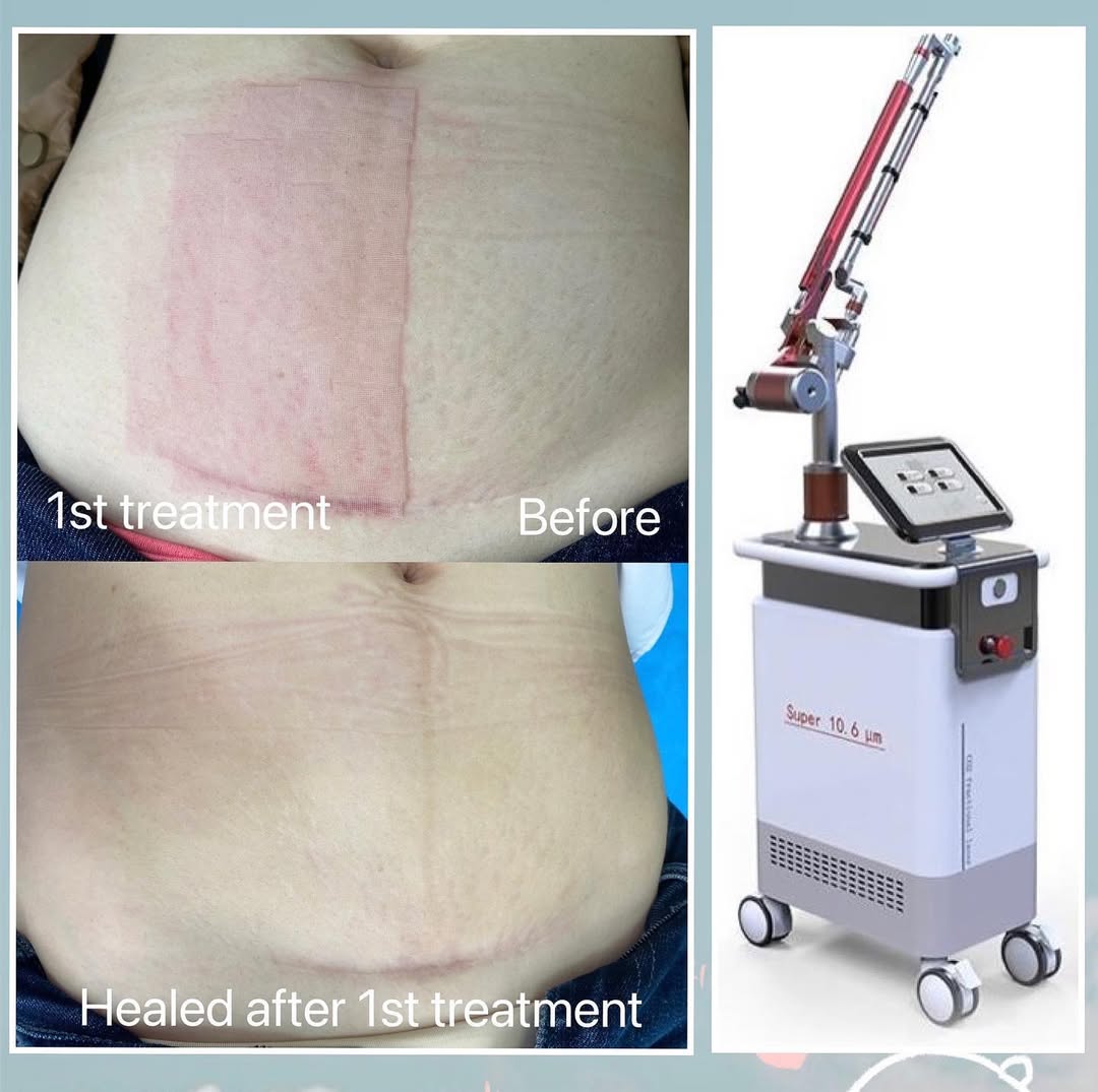 Stretch mark treatment for a patient