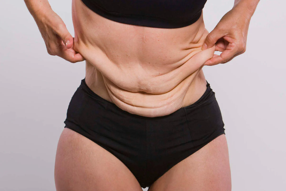 Best Clinic Treatments to Tighten Loose Skin After Weight Loss