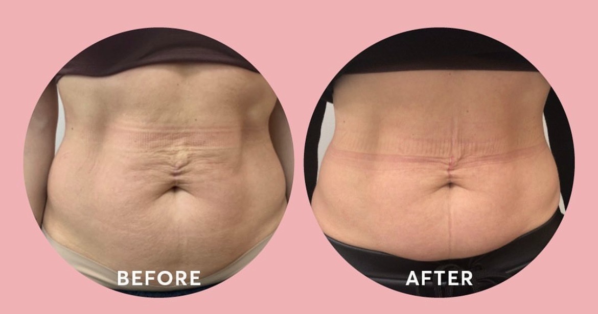 Skin tighteing with RF Microneedling before and after