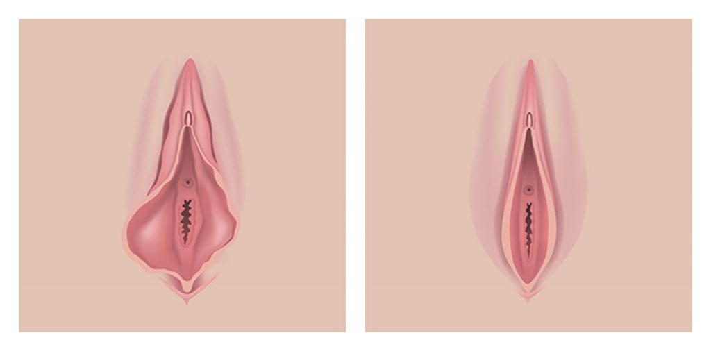 vaginal-rejuvenation-before-and-after