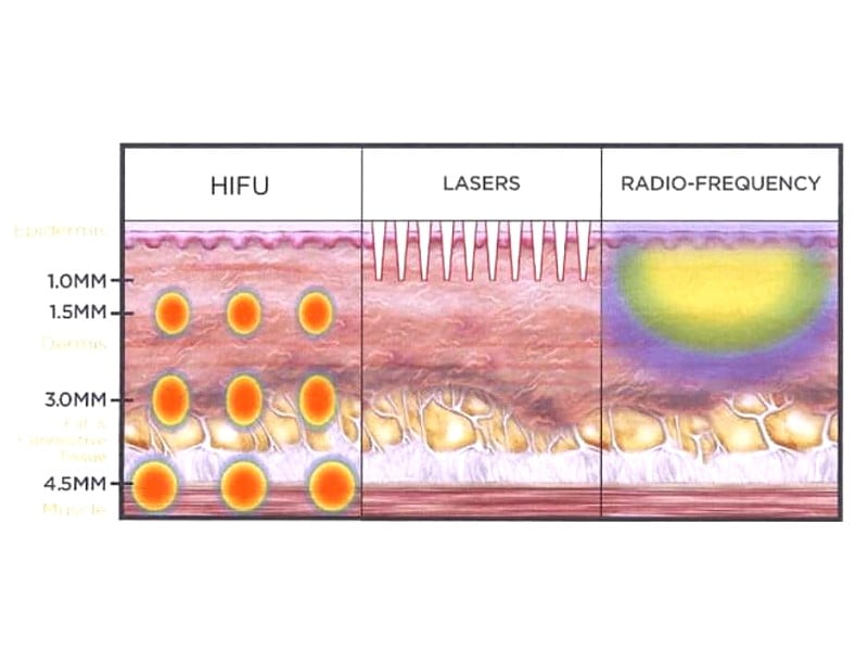 How HIFU Differs from Other Non-Invasive Technologies