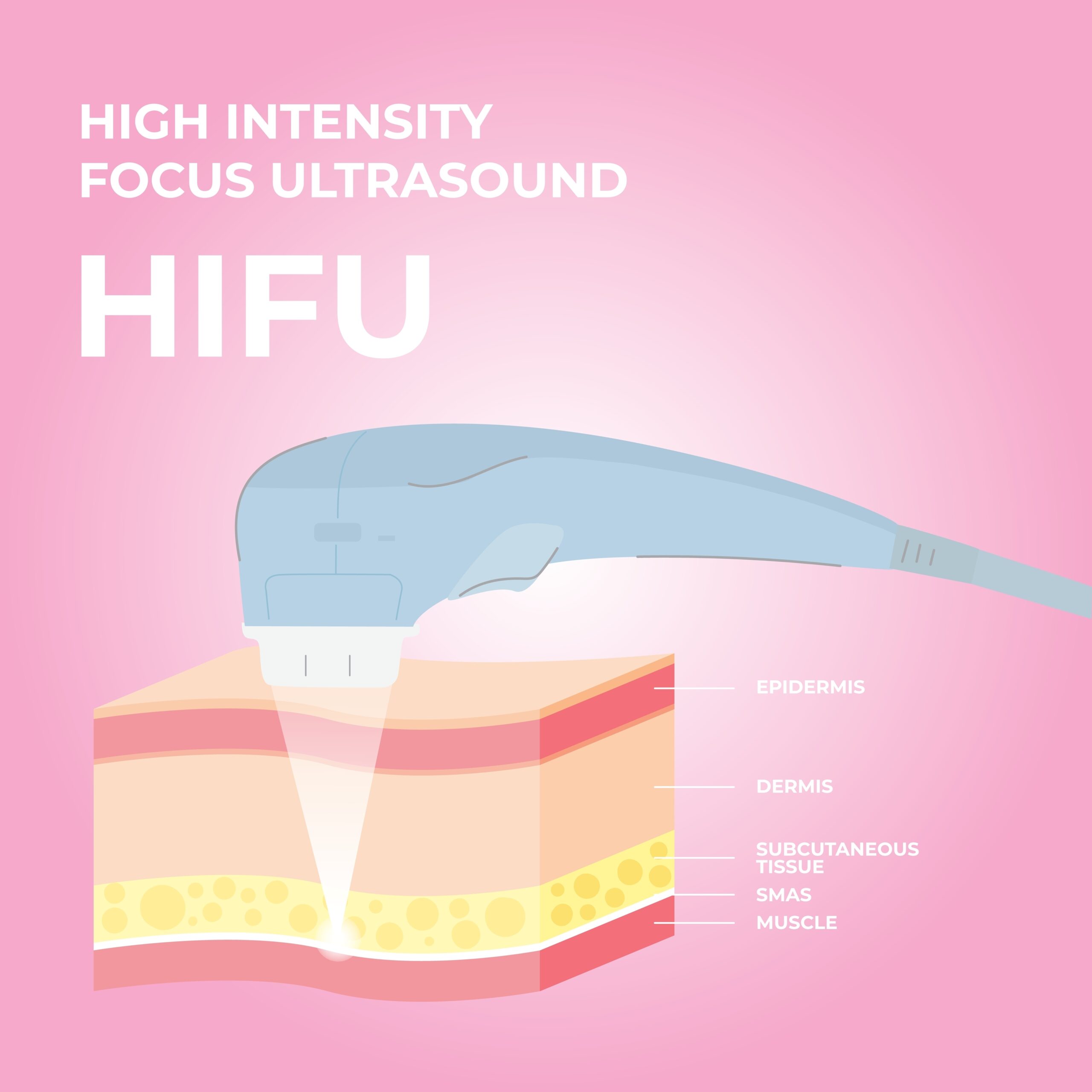 How Does HIFU Work?