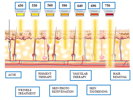 ipl-wavelengths-How IPL Technology Works
