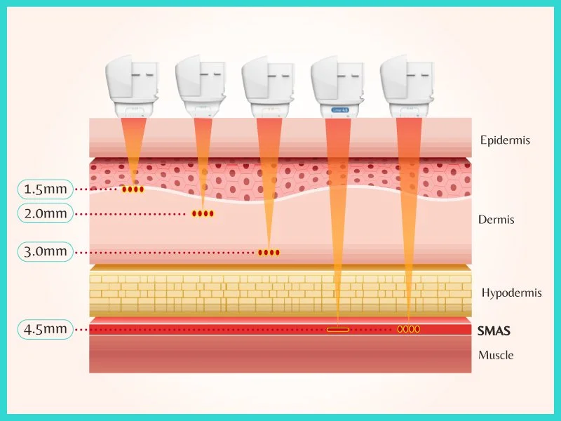 Multi-depth 7D HIFU treatments