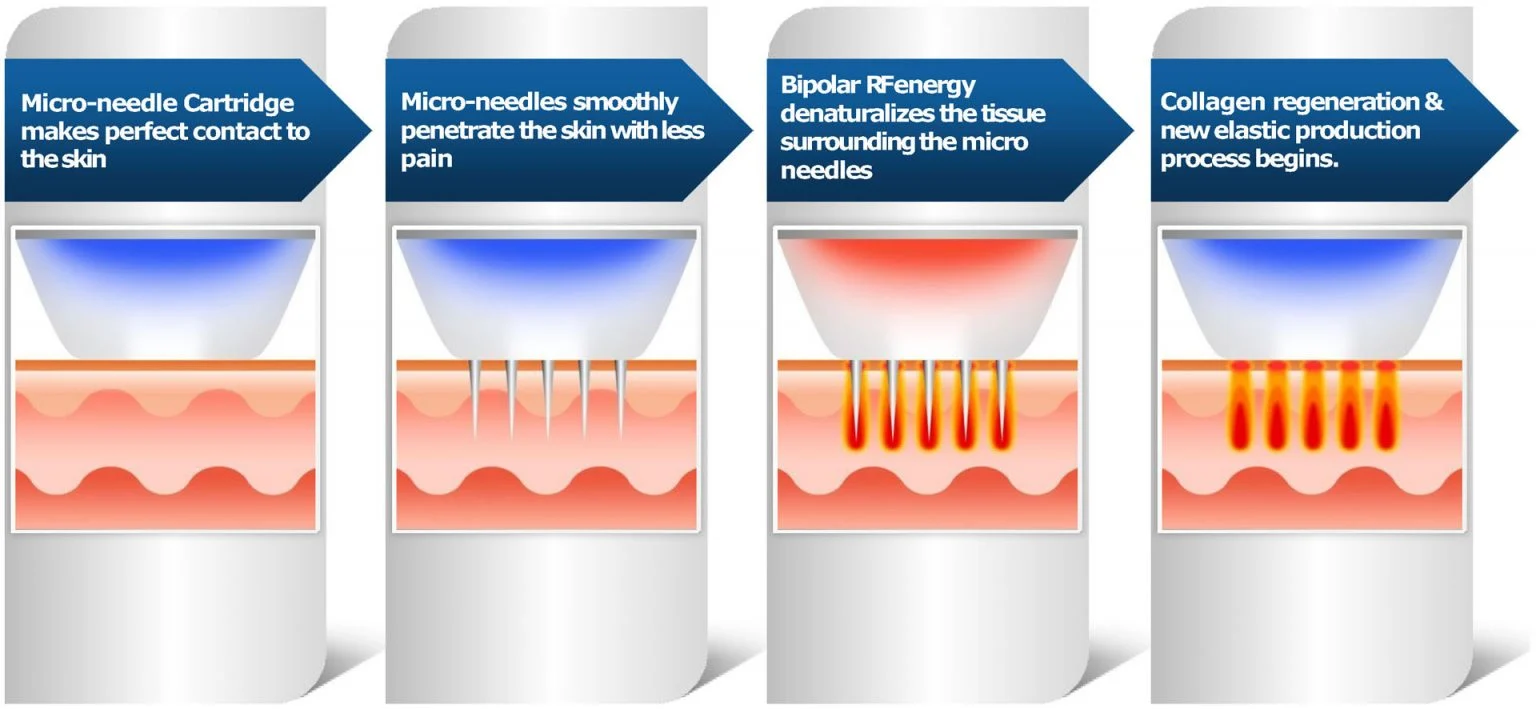 how rf microneedling works