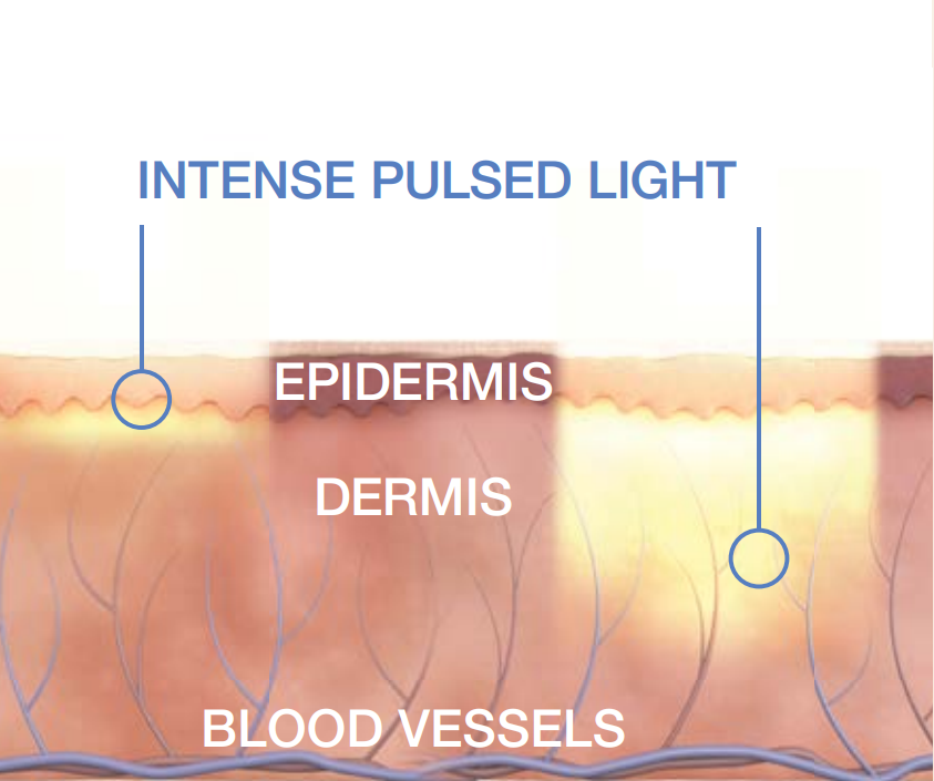 IPL rosacea treatment
