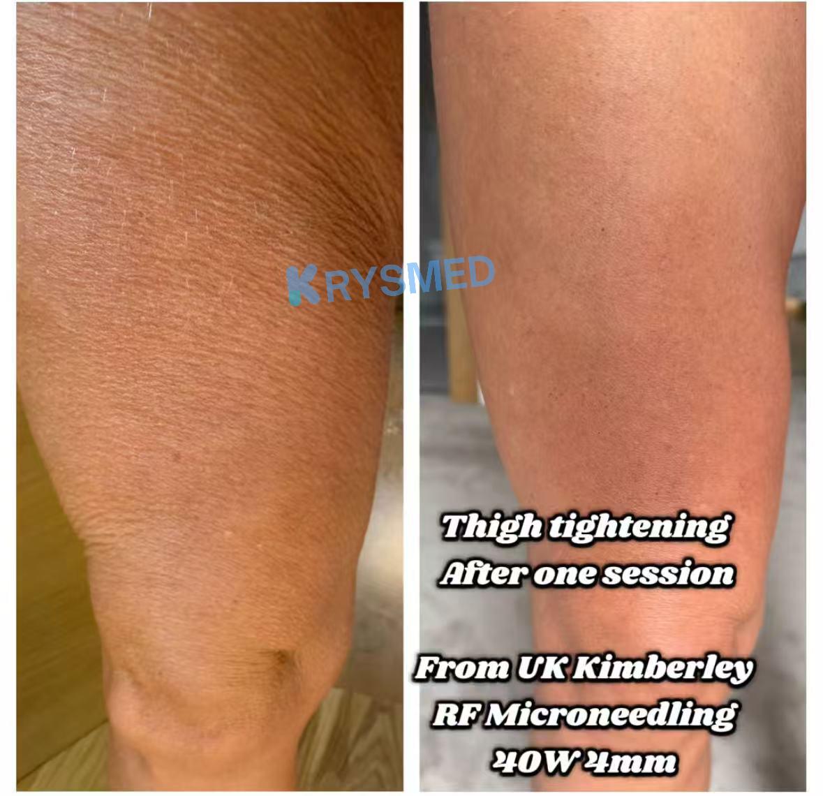 How RF Microneedling Works on Body Skin