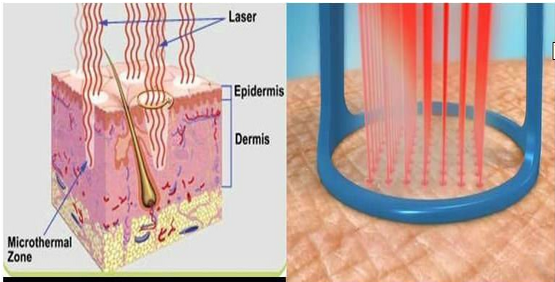 How Micro-Columns Stimulate Collagen Remodeling