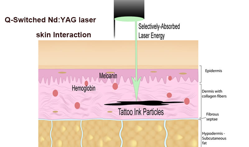 How Q-Switched Laser Works