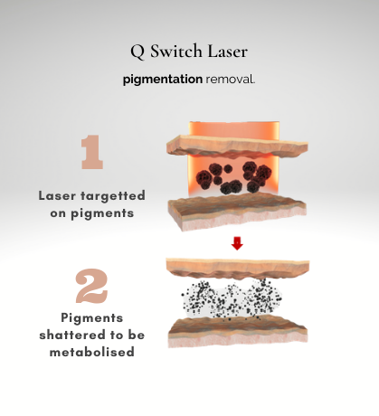 How Q-Switched Laser Treats Pigmentation