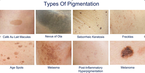 types of pgmentaion q switch can effectively treat